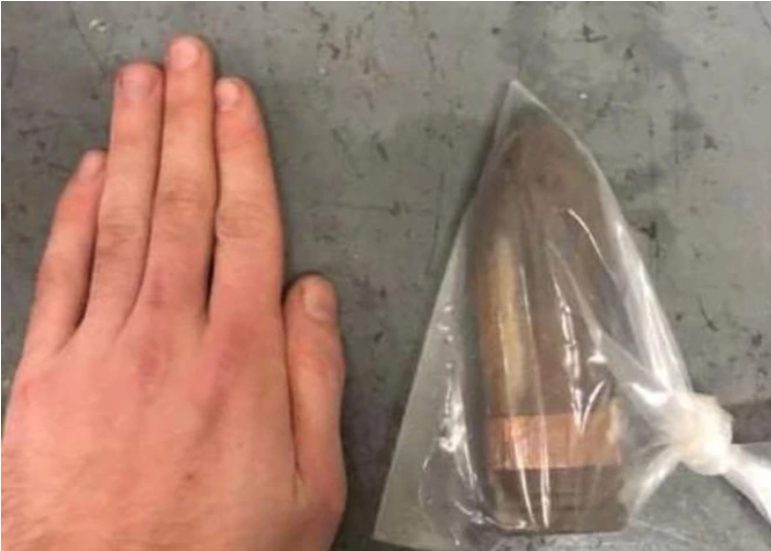 Mand fik 17cm stor patron op i numsen: “Han gled og faldt ned på den”