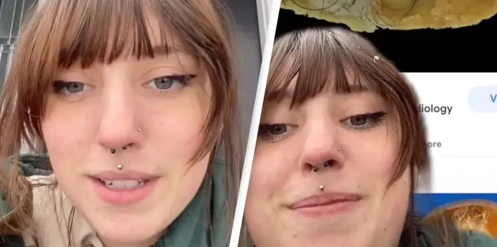 Kvinde efterladt chokeret efter undersøgelse: Hår og tænder voksede i hendes livmoder i årevis