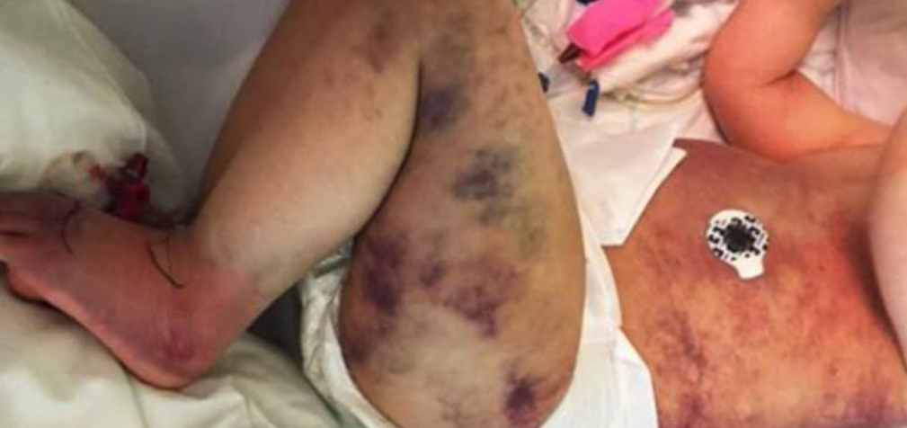 Mor troede, at hendes søn var blevet stukket af hvepse: Det viste sig at være meget værre