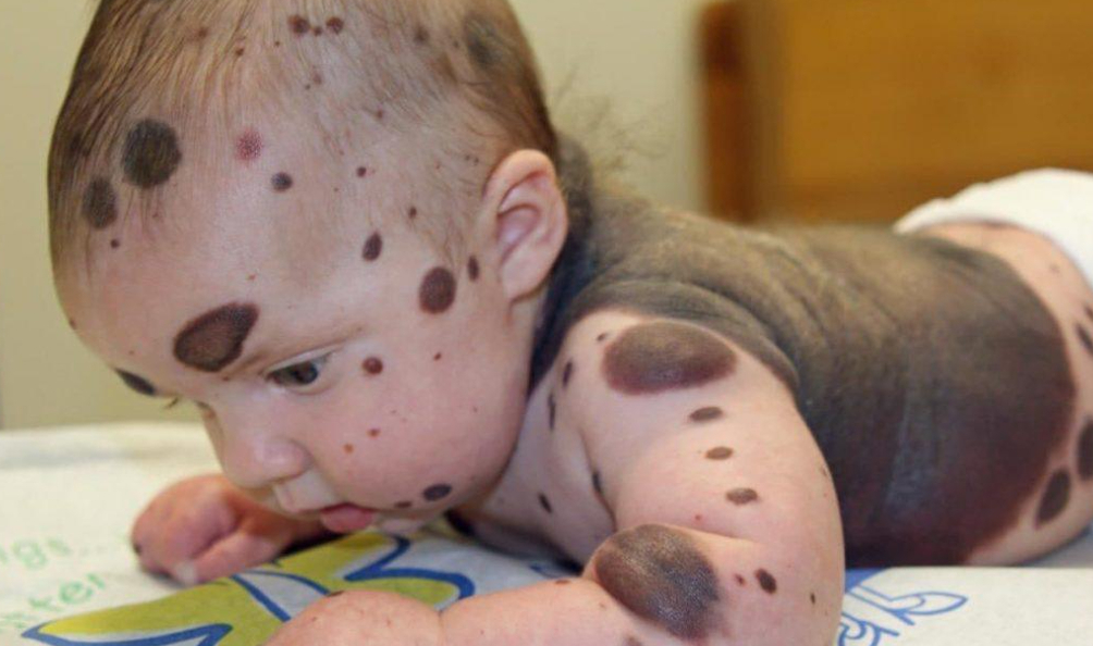 Baby blev født med sorte pletter: Så kom beskeden fra lægerne