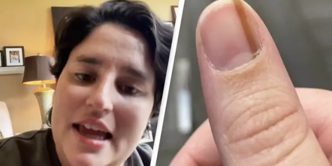 Kvinde troede, at stregen under neglen var harmløs: Nu advarer hun andre