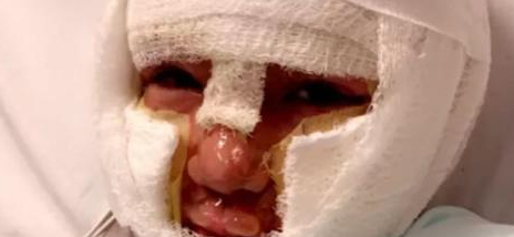 8-årig dreng satte ild til 6-årigt mobbeoffer: Mobberens mor mener ikke, han har gjort noget forkert