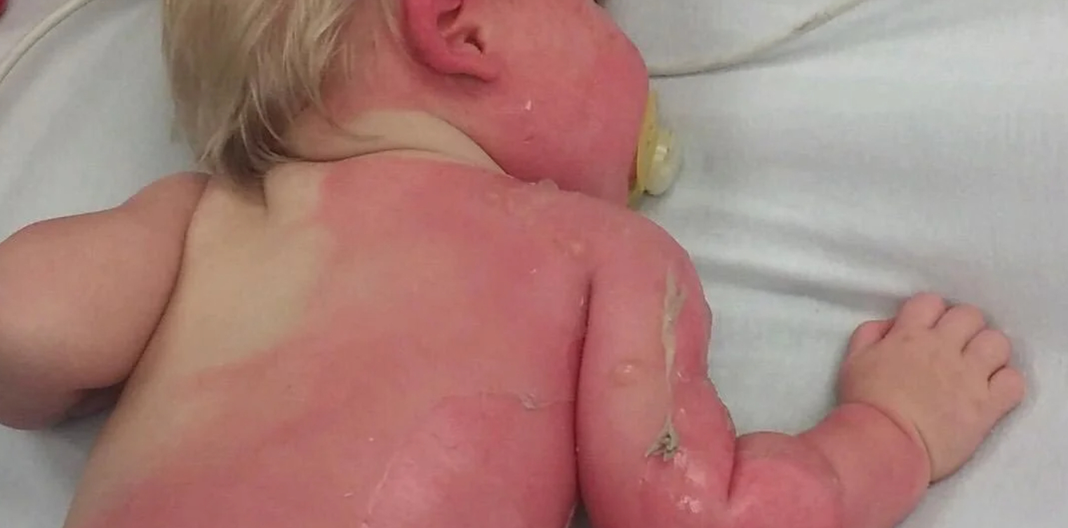 Mor advarer: Baby fik forbrændinger på 30 procent af kroppen