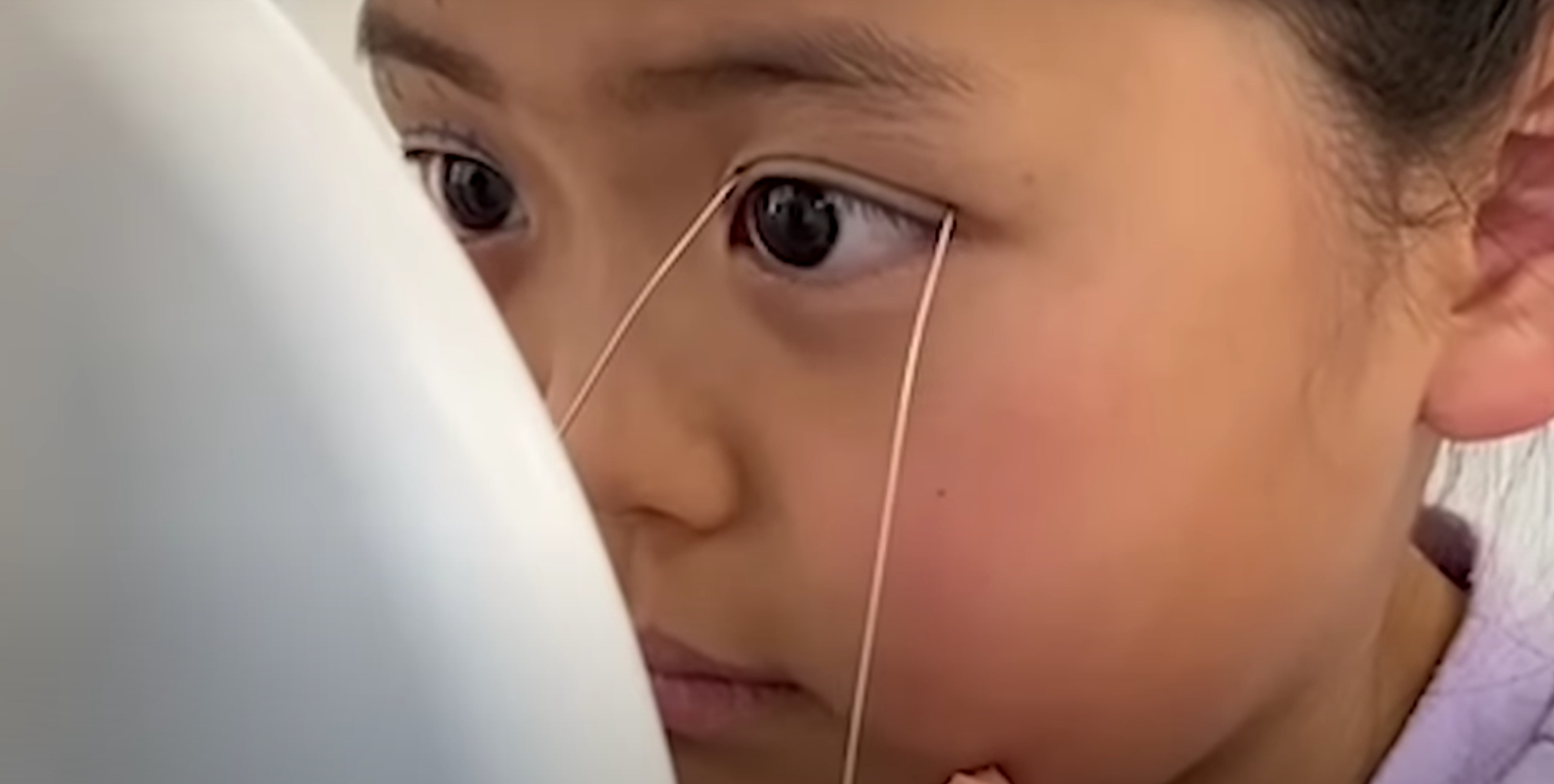 Gennemgik plastikoperation som 9-årig: Det er desværre ikke usædvanligt