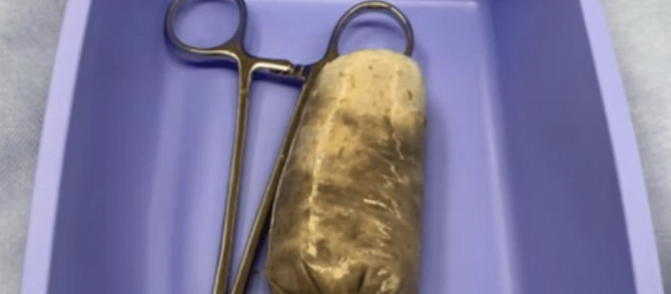 Chokerende fund i 34-årig mand: Du gætter ikke, hvad det er