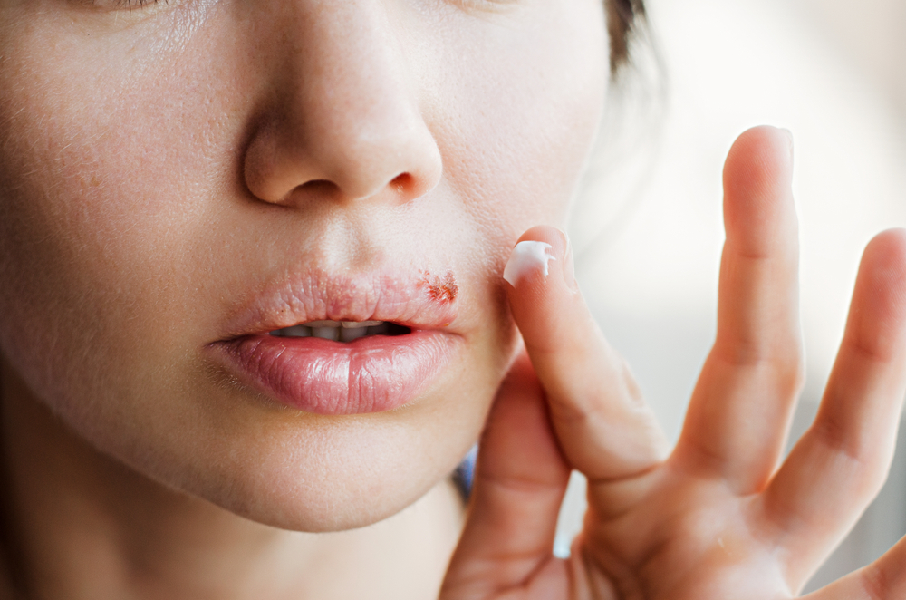 Sådan bliver du fri for herpes