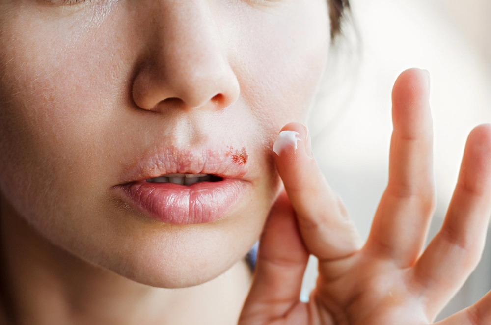 Sådan bliver du fri for herpes