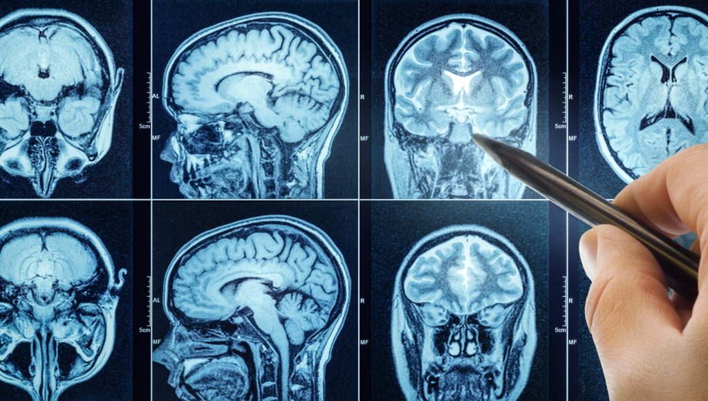Læge advarer mod almen vane ved sengetid: Kan øge din chance for Alzheimers