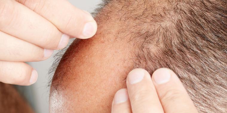 Ny forskning viser: Undgå at blive skaldet ved at gnide wasabi på dit hoved