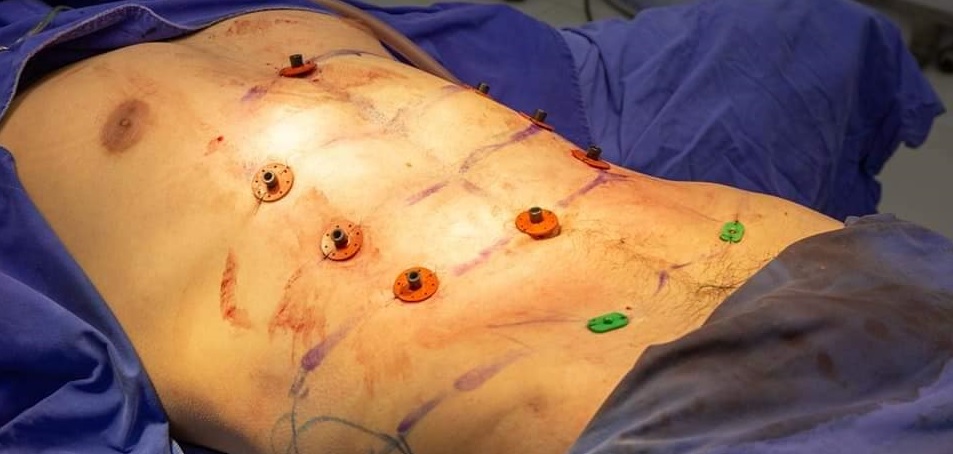 Nu kan du få en six-pack via en kosmetisk operation