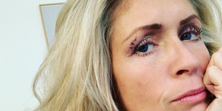 Dramatisk optakt til ‘Vild med dans’: Blodigt uheld