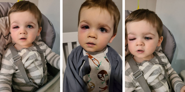 2-årig drengs øje svulmer op til dobbelt størrelse: Nu advarer mor andre