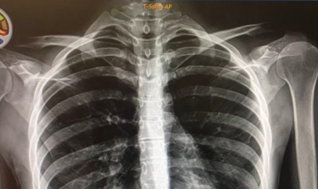 Ups! Mor var taget med sin datter på hospitalet, da røntgenfoto afslørede pinlig hemmelighed