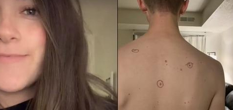 Kvinde tvinger sin mand til hudlæge: Kommer hjem dækket af notater