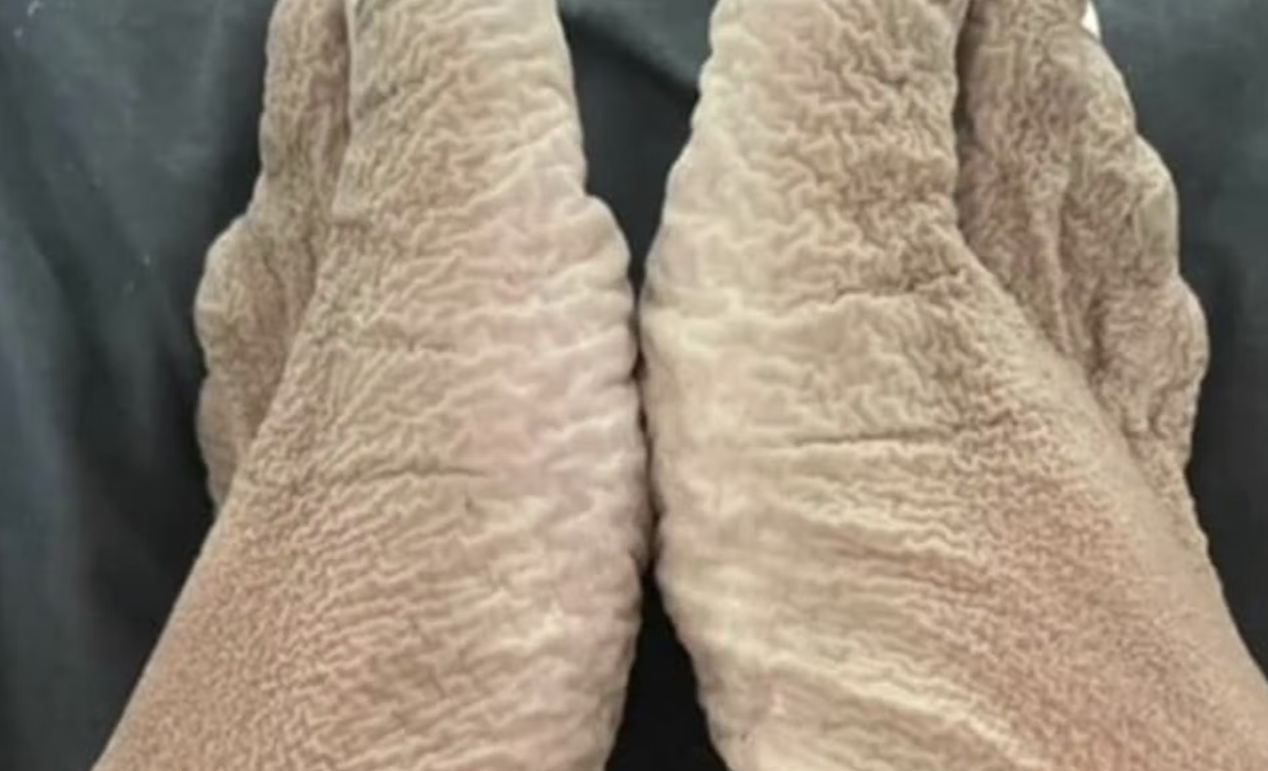 Kvinde tog 16 timer langt fodbad ved en fejl: Sådan så hendes fødder ud