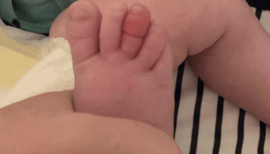 Mor udsender advarsel til forældre: Hårstrå kostede næsten 5 måneder gammel baby sin tå