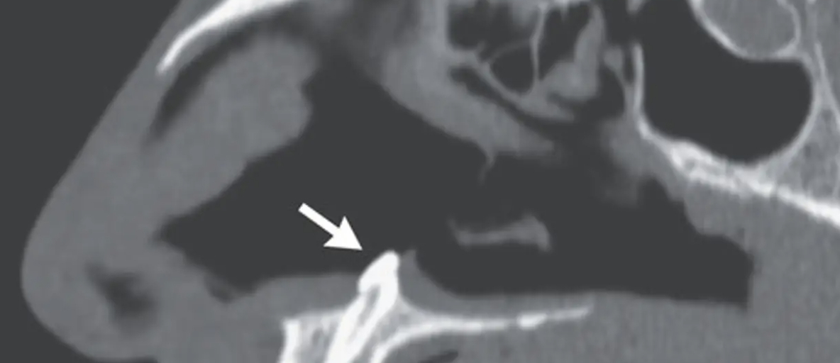 Mand havde vejrtrækningsproblemer: Så opdagede man, at en tand voksede i hans næse