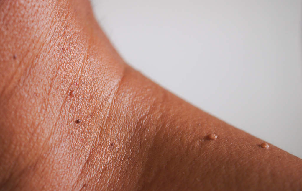 Flere danskere døjer med dette problem: Så enkelt kan du slippe af med dem