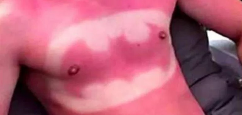 Ekspert advarer mod farlige trend: Folk dropper solcreme for at lave “tatoveringer”