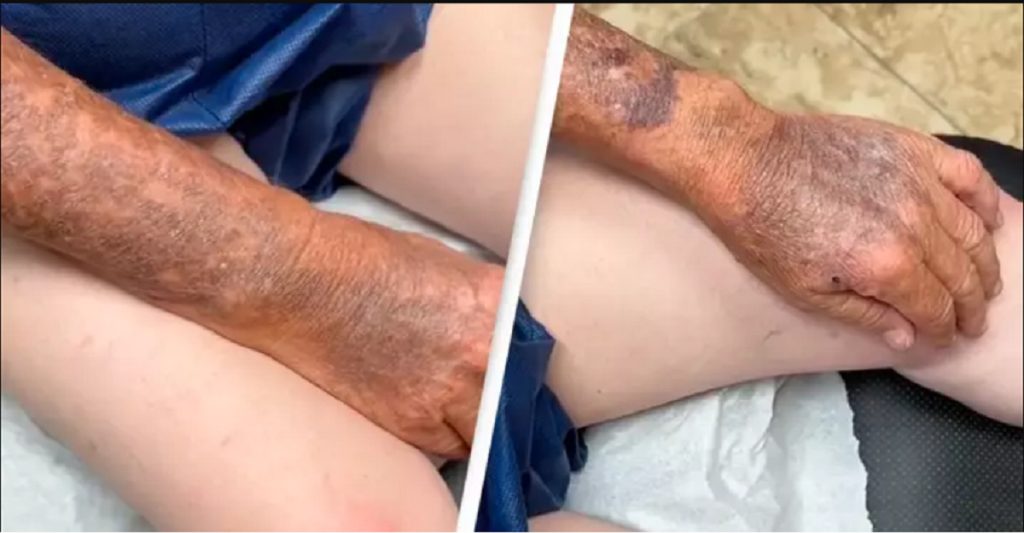 Mands hud viser vigtigheden ved solcreme