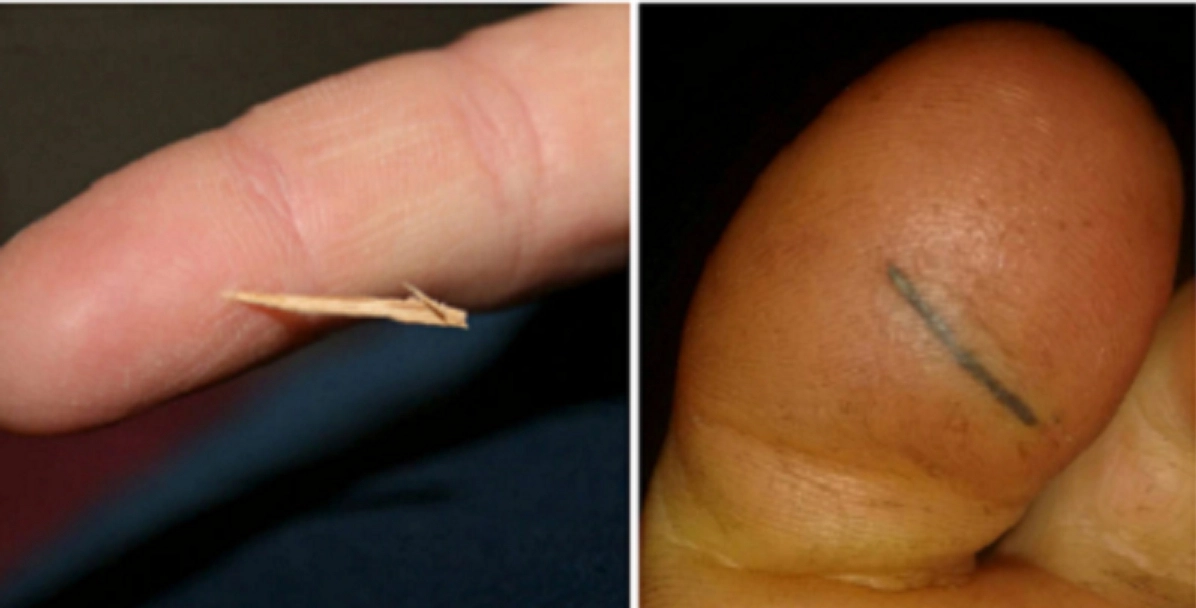 Genialt trick: Sådan fjerner du nemt og enkelt splinter