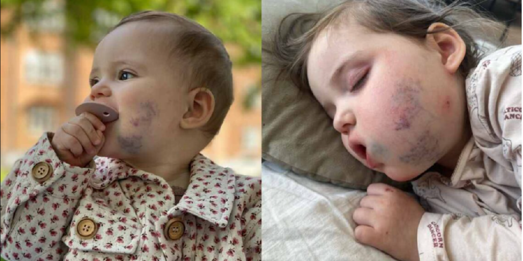 Det startede som et lille mærke på kinden: Så kom den tårevældende sandhed frem