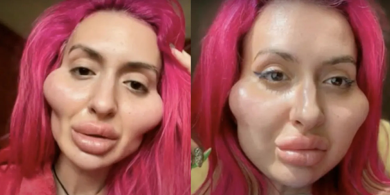Influencer med verdens største kinder deler billeder fra før transformationen