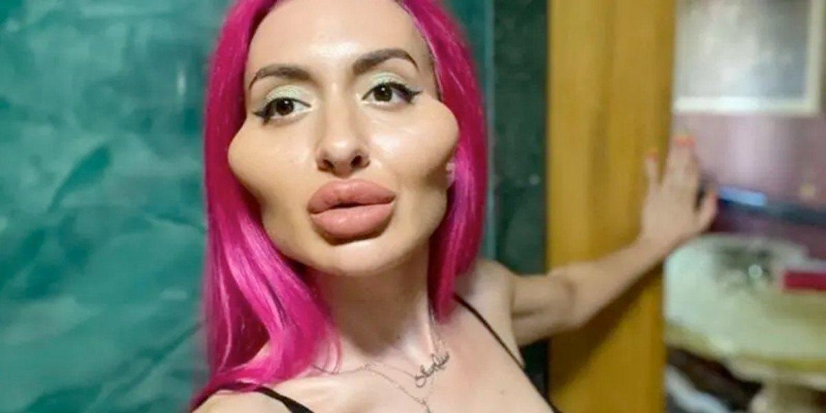 Kvinde kendt som ‘kvinden med verdens største kinder’ er uigenkendelig på billede taget for 6 år siden