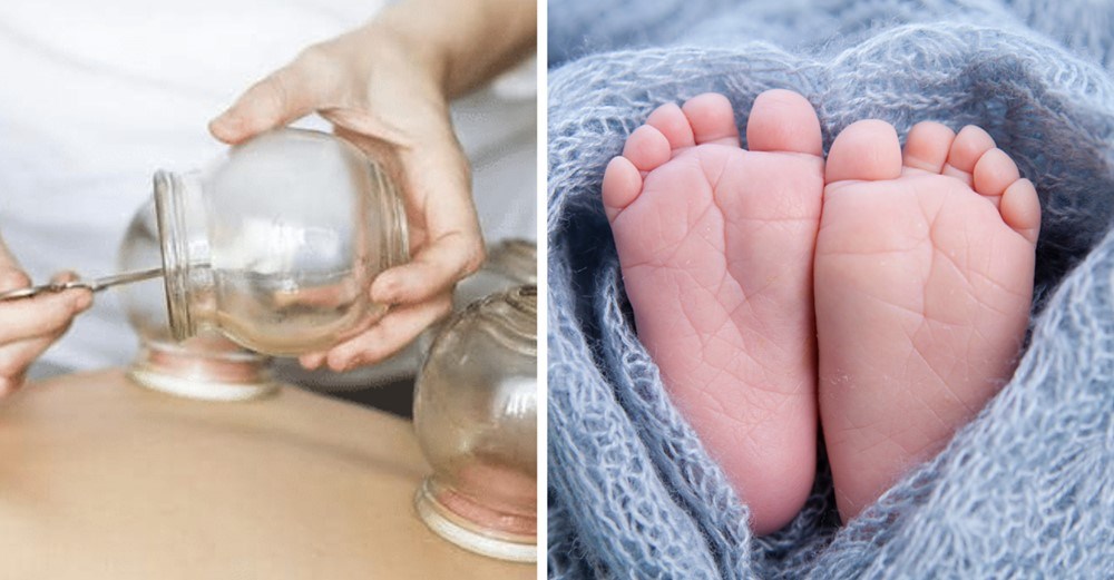 Folk raser over billede af 3 måneder gammel baby, der får sugekop-behandling