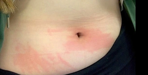 21-årig pige allergisk over for vand: Får feber når hun græder