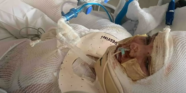 Livsfarlig udfordring på TikTok: 13-årig pige kæmper for sit liv