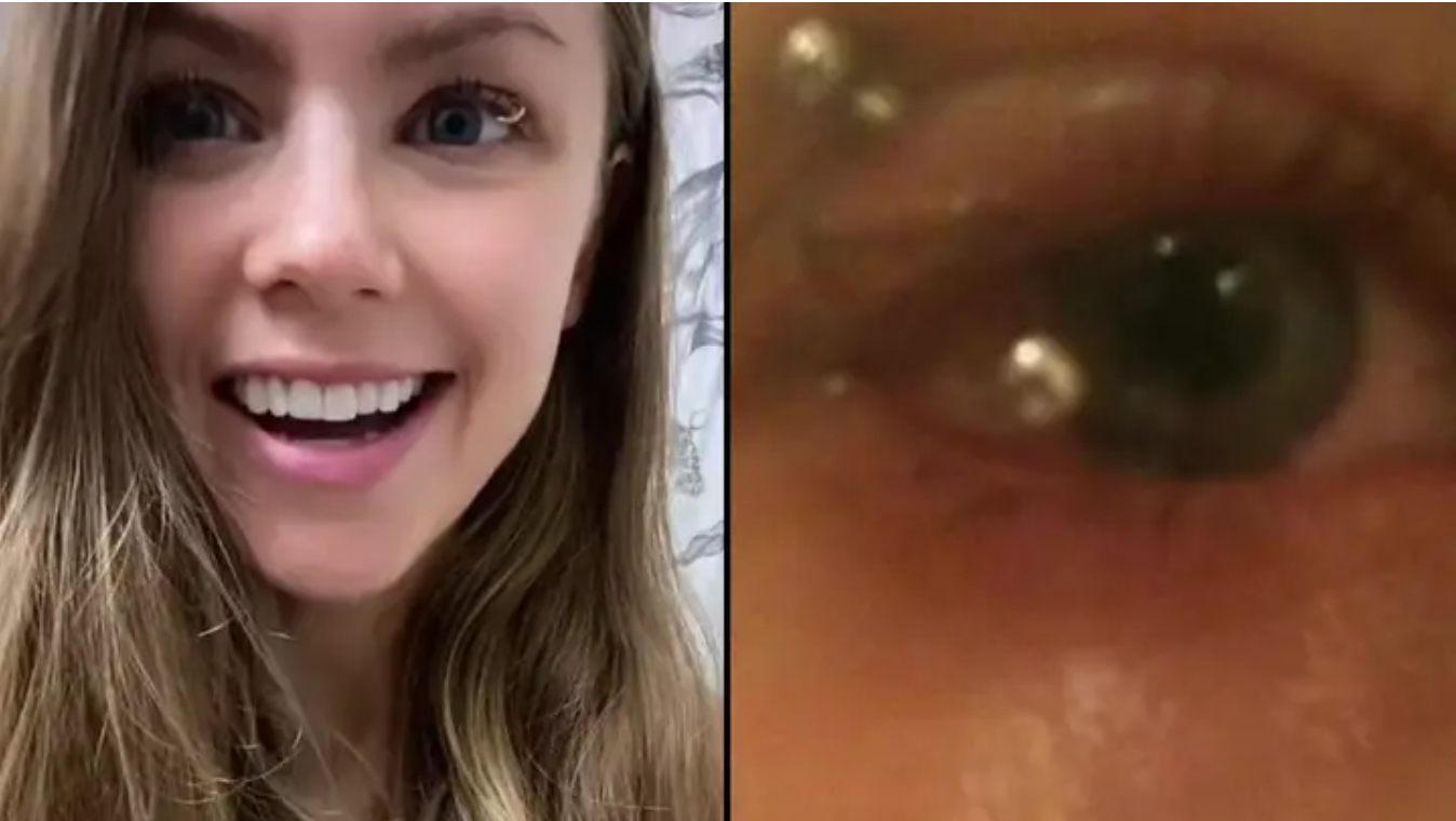 Kvinde får sit øjenlåg piercet: Var hævet i flere måneder