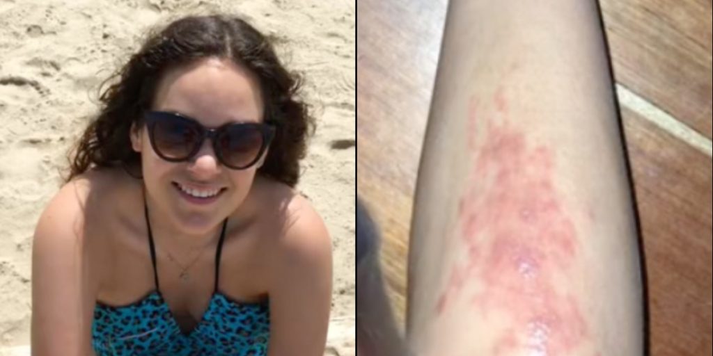 Kvinde havde irriterende udslæt på benet: Viste sig at være noget helt andet