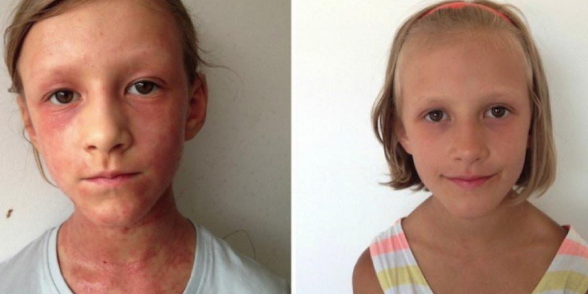 Maya var hårdt ramt af eksem, men så ændrede hendes mor noget enkelt i kosten