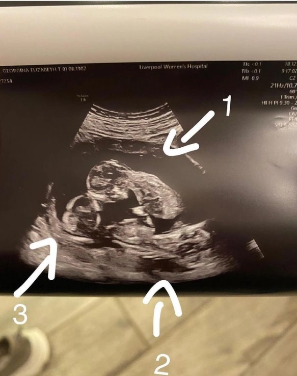 Var gravid med trillinger: Så opdagede lægerne en unik detalje