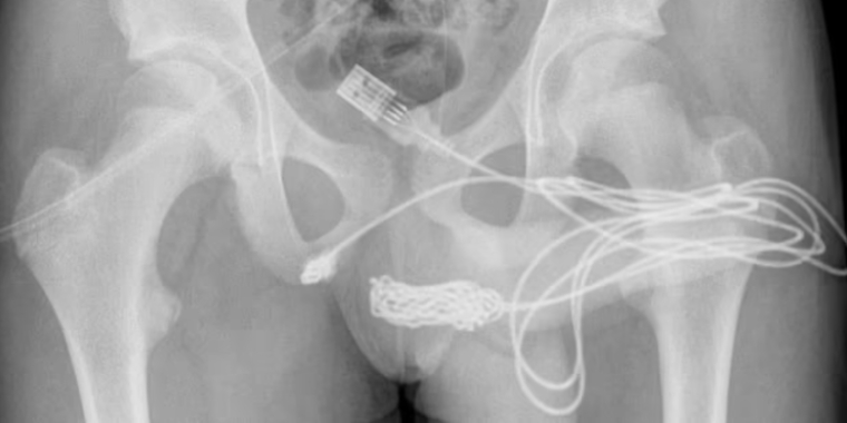 15-årig dreng proppede stort USB-kabel op i sin diller: Skulle teste hvor lang den var