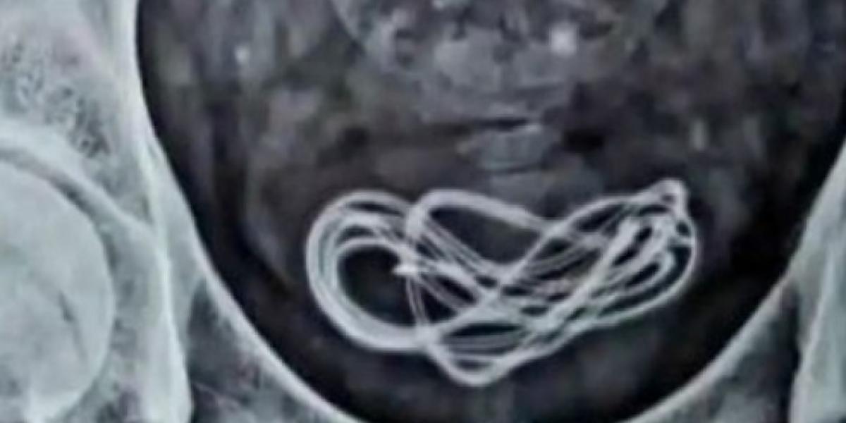 Mand slugte 60 centimeter langt kabel – Men ikke med munden