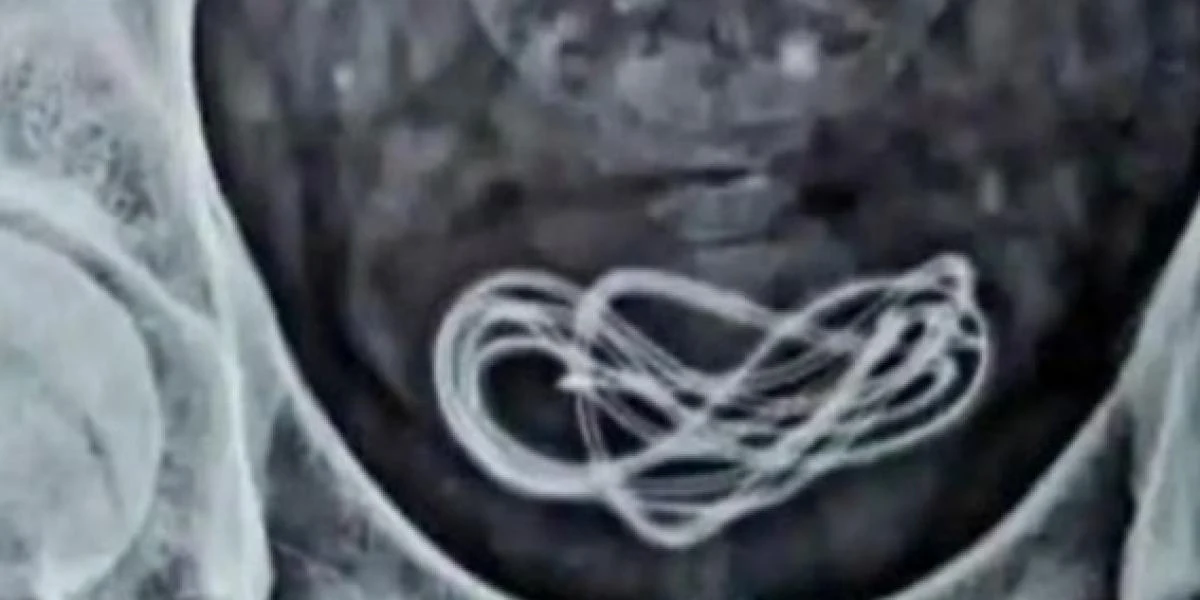 Mand slugte 60 centimeter langt kabel – Men ikke med munden