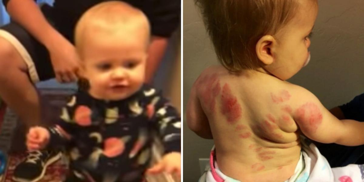 Mor opdager grusomme mærker på datteren: Raser da hun opdager, hvad der er sket i vuggestuen